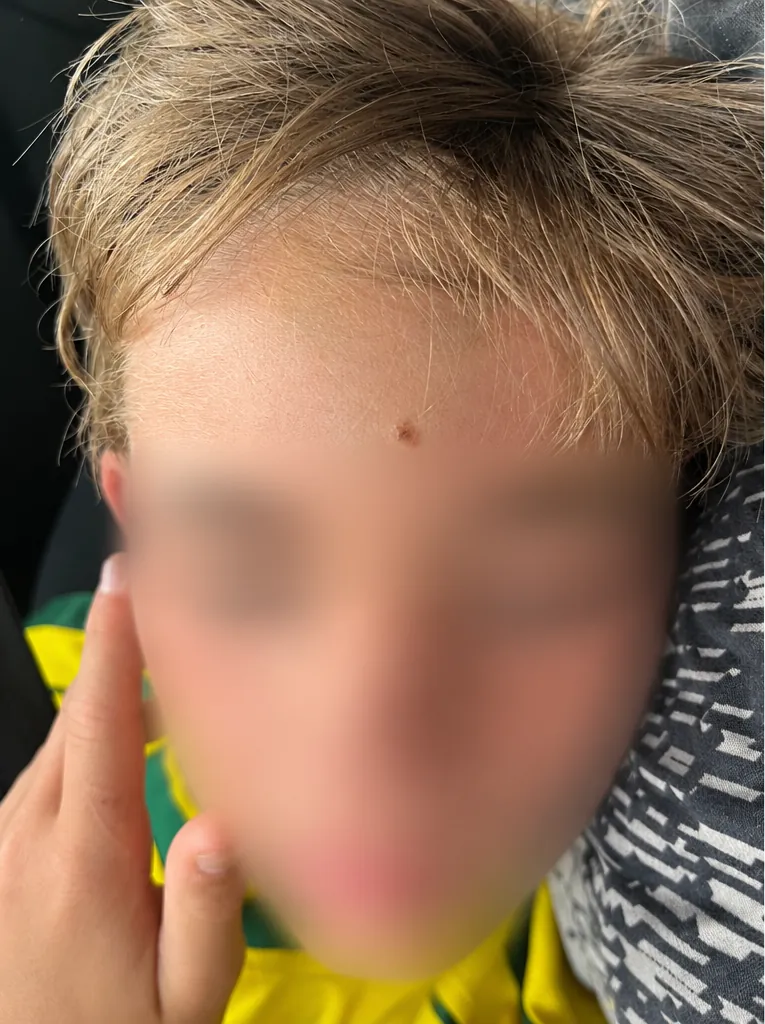 Une bosse au front, photo envoyée pour couper la douleur